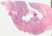 Myoepithelioma (Salivary glands) [223/1]