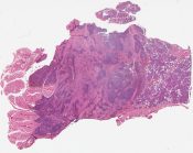 Malignant lymphoma (Salivary glands) [223/8]