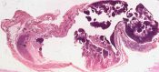Warthin's tumor          (Salivary glands) [66/14b]