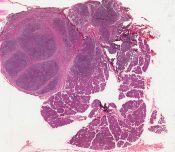 Adenocarcinoma          (Salivary glands) [66/15b]